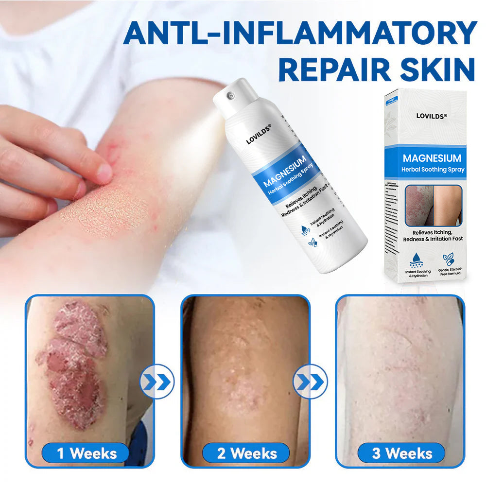 LOVILDS® Magnesium Herbal Psoriasis Spray
