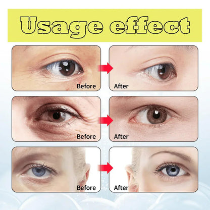 Eye tightener