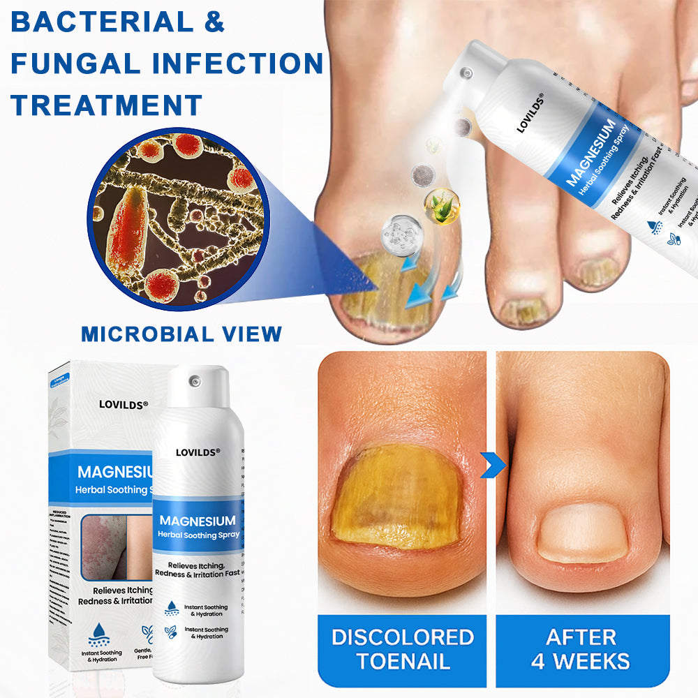 LOVILDS® Magnesium Herbal Psoriasis Spray