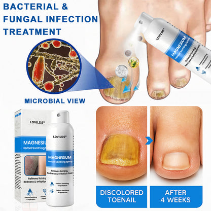 LOVILDS® Magnesium Herbal Psoriasis Spray