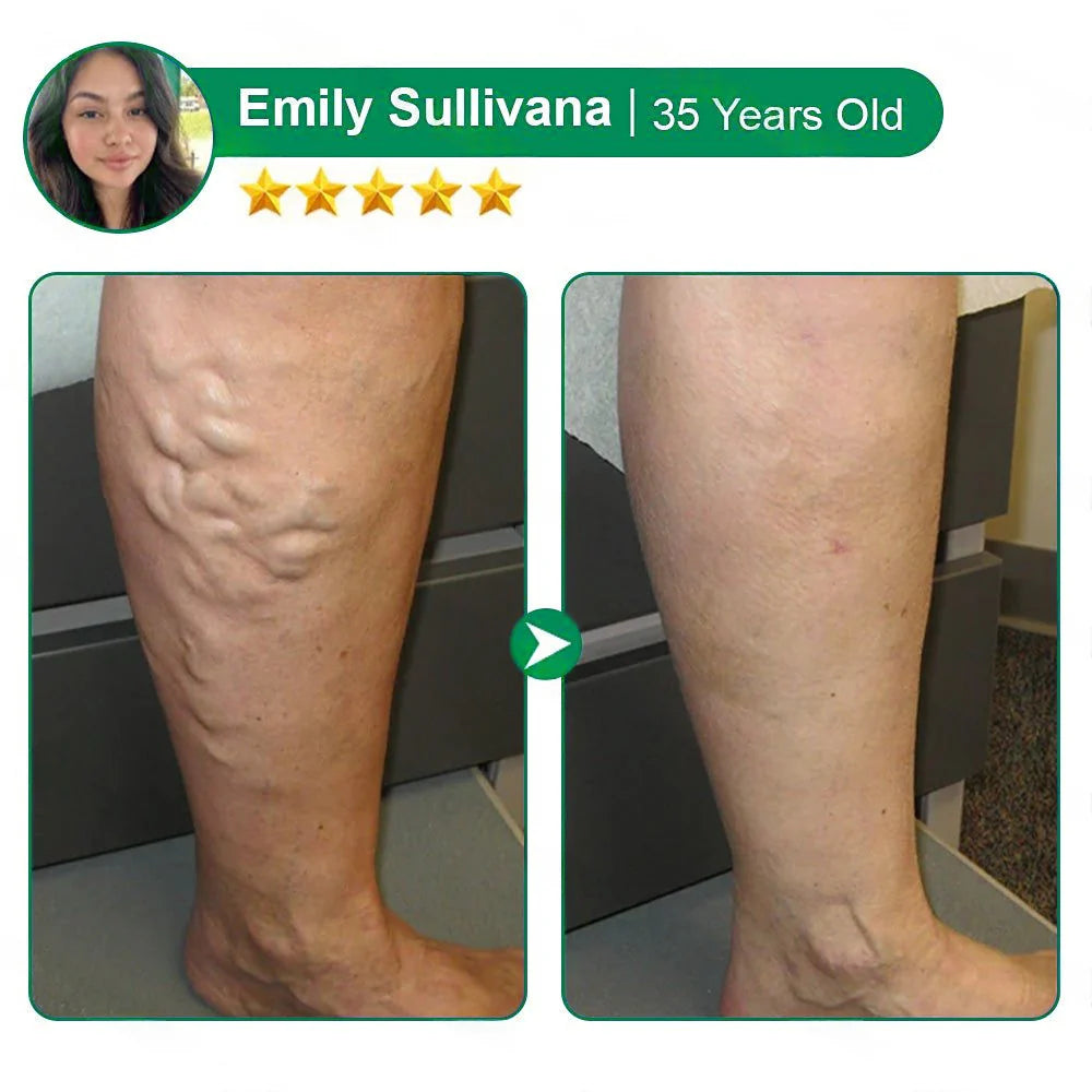 💧Alisanda® VeinTarget Microneedle Patch⚡Instant Relief, Long-Term Results