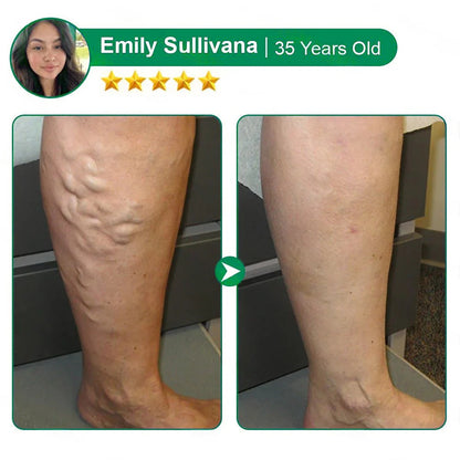 💧Alisanda® VeinTarget Microneedle Patch⚡Instant Relief, Long-Term Results