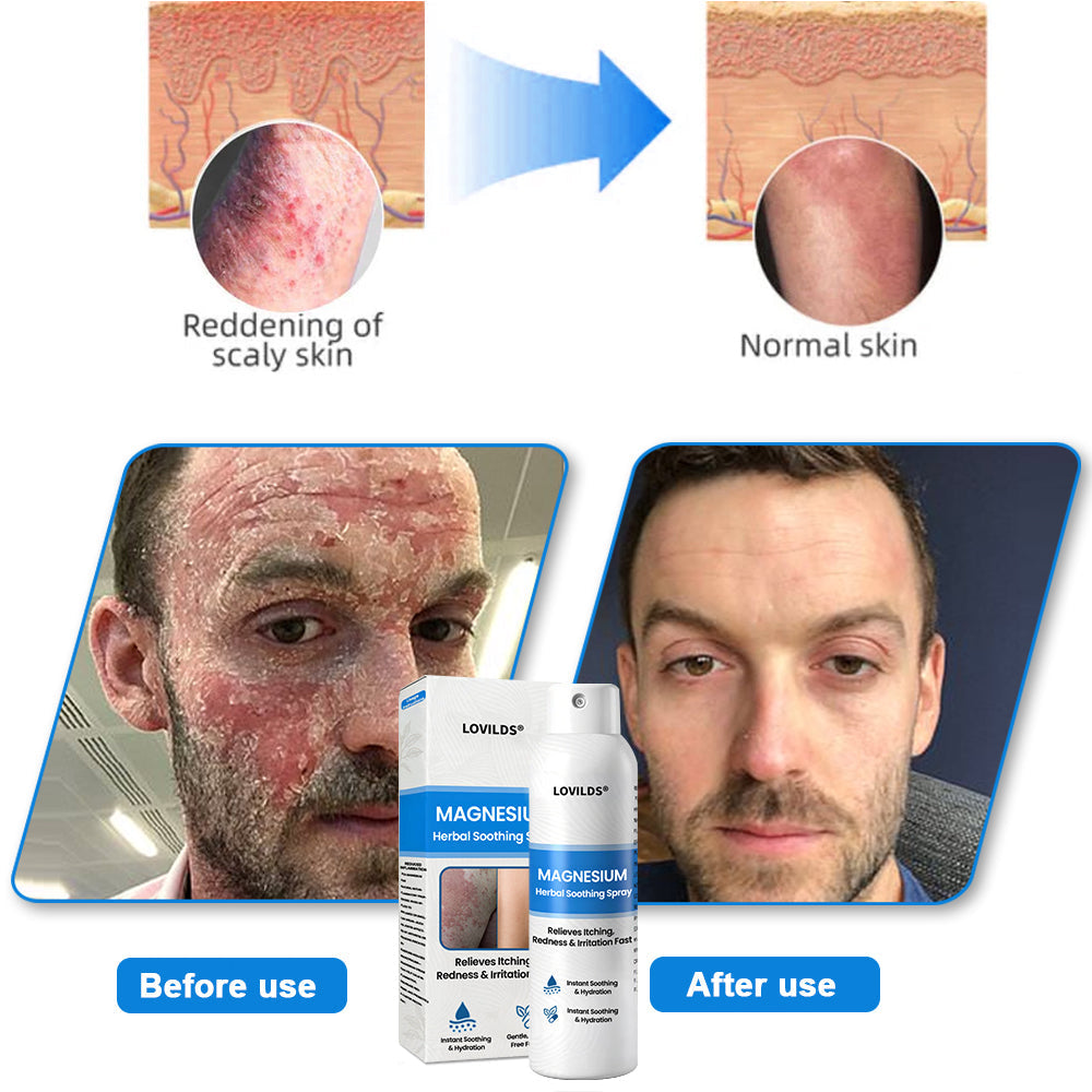 LOVILDS® Magnesium Herbal Psoriasis Spray