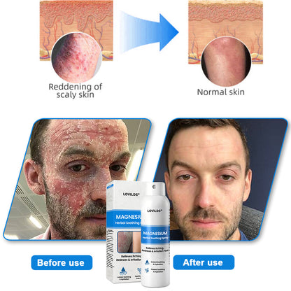 LOVILDS® Magnesium Herbal Psoriasis Spray