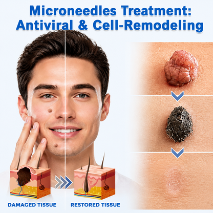 Alisanda®2-in-1 Microneedle & Hydrocolloid Patch🍀| Removes Raised Moles, Acne, Flat Warts & Skin Tags