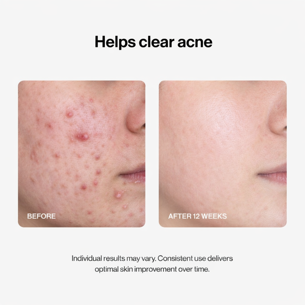 Alisanda® 24H Acne & Pimple Serum