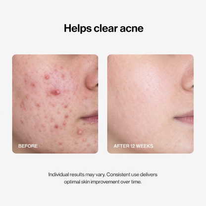 Alisanda® 24H Acne & Pimple Serum
