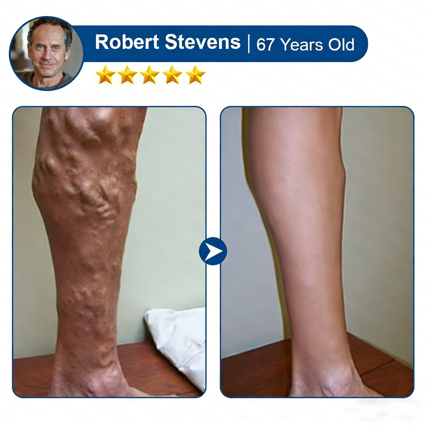 🇺🇸👨‍⚕️✅TAILEDEN® 𝑽𝗲𝗶𝙣 𝘾𝐨𝐧𝘁𝗼𝙪𝙧 𝙈𝙞𝐜𝐫𝒐𝒏𝒆𝗲𝗱𝗹𝙚 𝙋𝙖𝐭𝐜𝒉 𝒘𝒊𝘁𝗵 𝗔𝙙𝙫𝙖𝙣𝙘𝐞𝐝 𝐃𝒊𝒐𝒔𝗺𝙞𝐧 & 𝑯𝒆𝘀𝗽𝗲𝙧𝙞𝙙𝙞𝐧 𝐃𝒆𝒍𝒊𝒗𝗲𝗿𝙮🌿𝟕-𝐃𝐚𝐲 𝐕𝐢𝐬𝐢𝐛𝐥𝐞 𝐑𝐞𝐬𝐮𝐥𝐭𝐬 𝐟𝐨𝐫 𝐕𝐚𝐫𝐢𝐜𝐨𝐬𝐞 𝐕𝐞𝐢𝐧𝐬