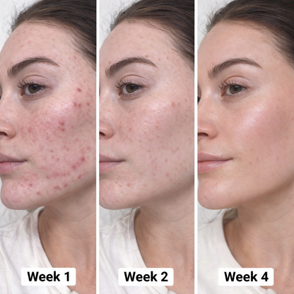Alisanda® 24H Acne & Pimple Serum