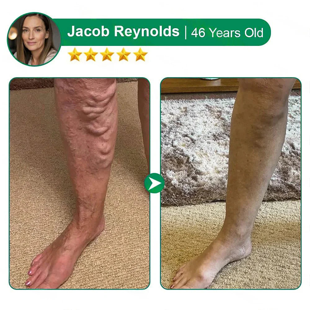 💧Alisanda® VeinTarget Microneedle Patch⚡Instant Relief, Long-Term Results