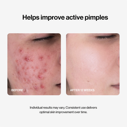 Alisanda® 24H Acne & Pimple Serum