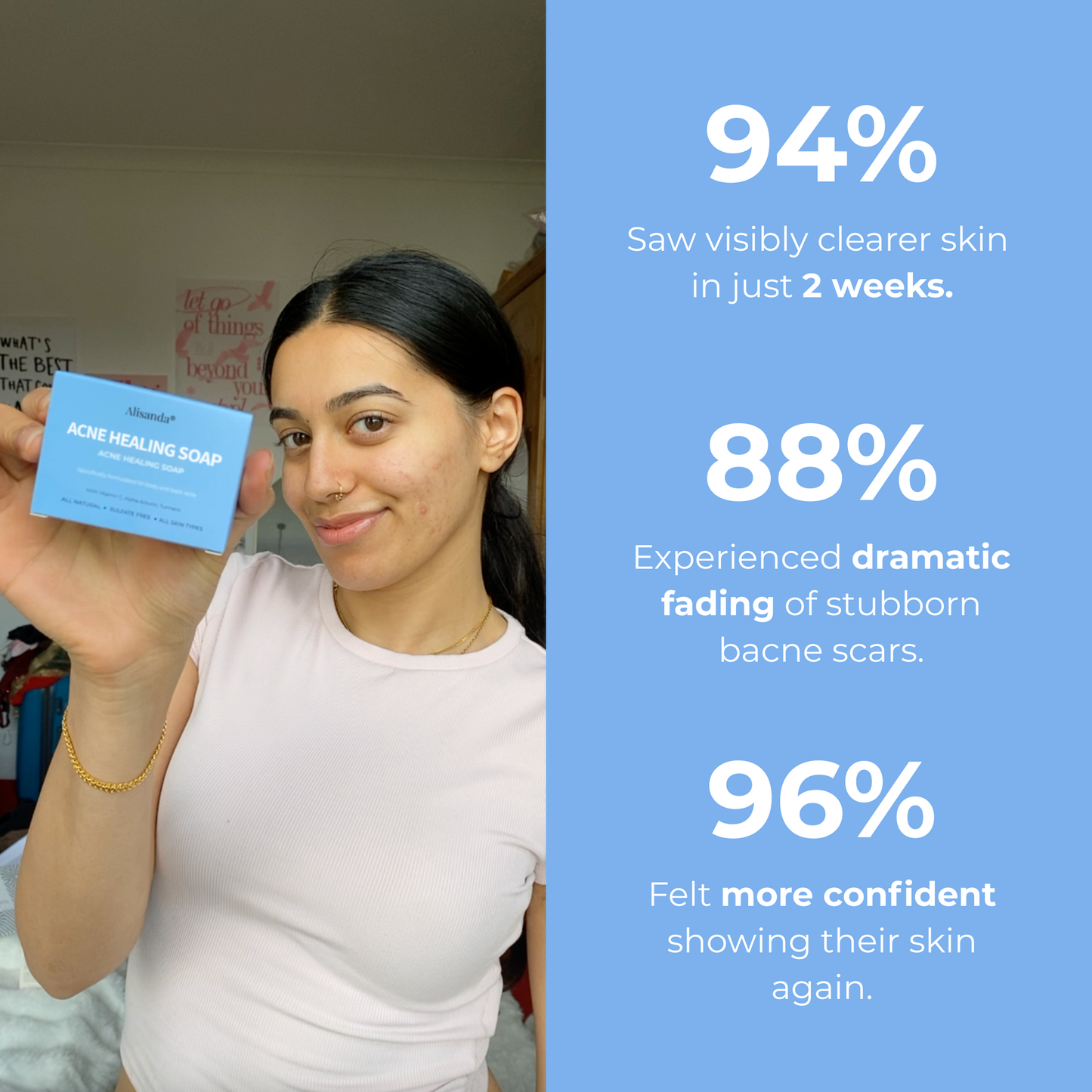 ACNE HEALING SOAP