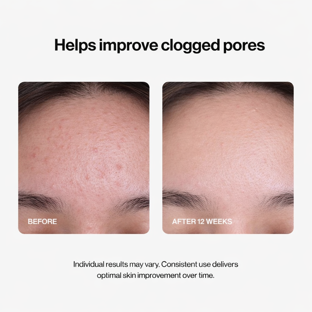 Alisanda® 24H Acne & Pimple Serum