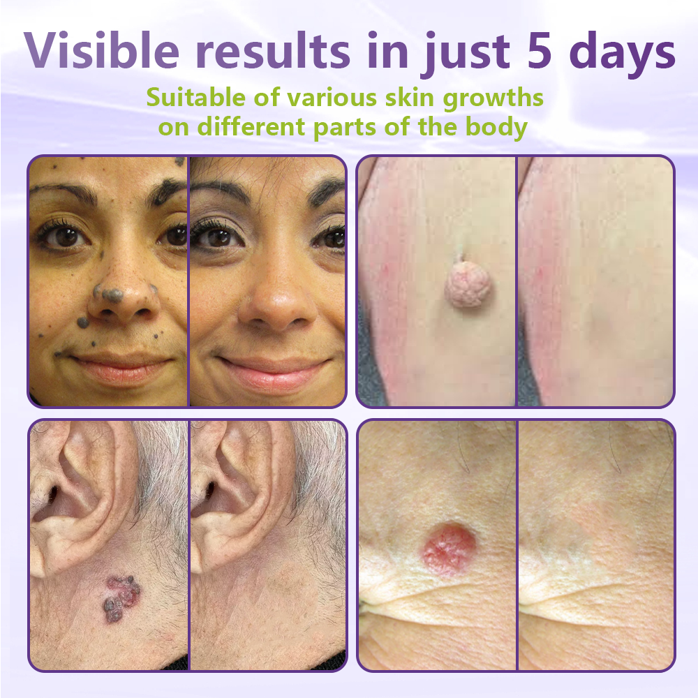 🔥🔥NESLEMY® Soluble Microneedle Botanical Skin Tag Removal Patch