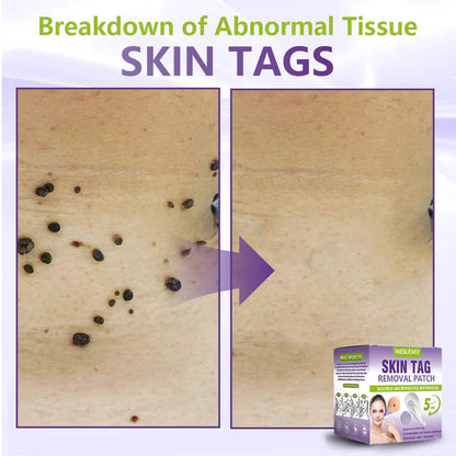 🔥🔥NESLEMY® Soluble Microneedle Botanical Skin Tag Removal Patch