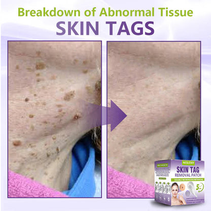 🔥🔥NESLEMY® Soluble Microneedle Botanical Skin Tag Removal Patch