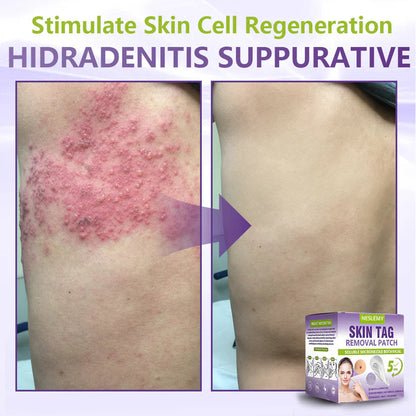 🔥🔥NESLEMY® Soluble Microneedle Botanical Skin Tag Removal Patch