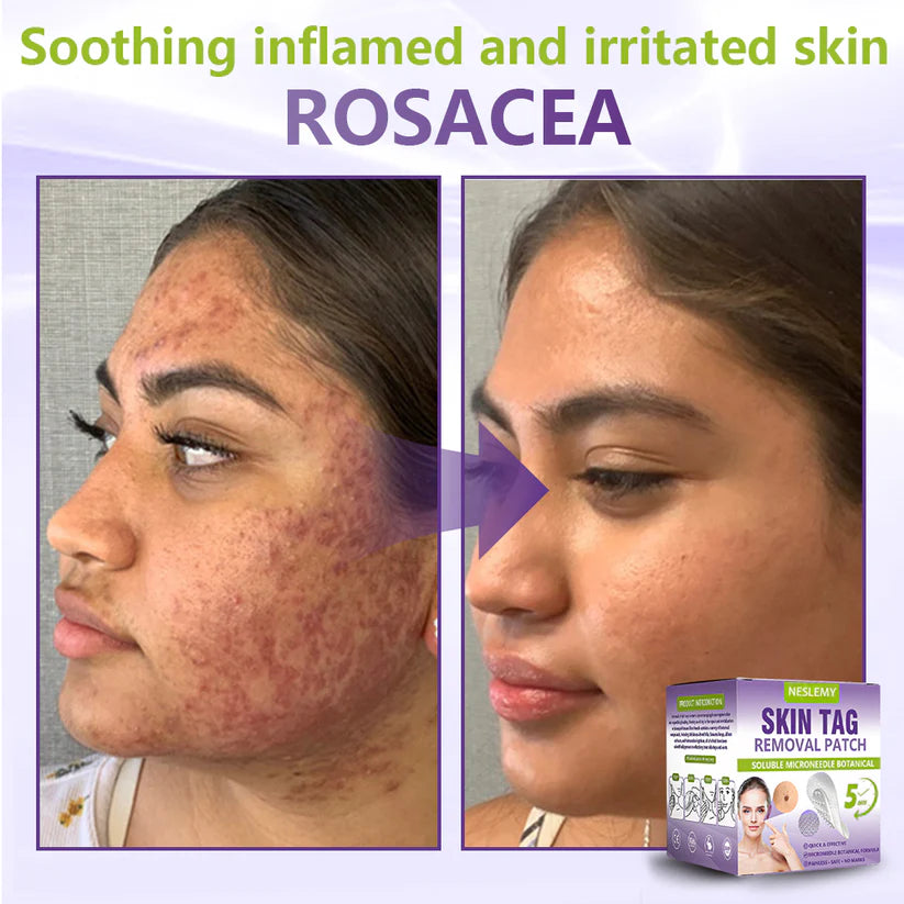🔥🔥NESLEMY® Soluble Microneedle Botanical Skin Tag Removal Patch