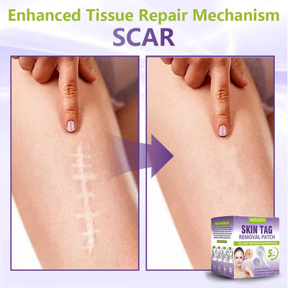 🔥🔥NESLEMY® Soluble Microneedle Botanical Skin Tag Removal Patch