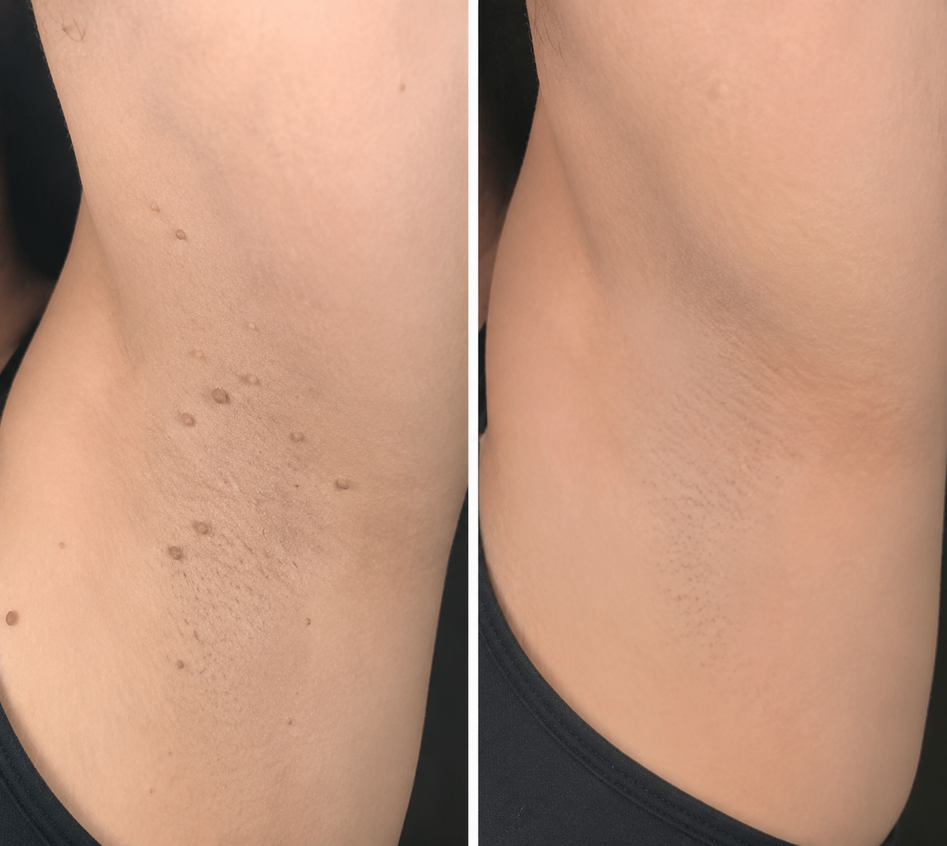 Alisanda®2-in-1 Microneedle & Hydrocolloid Patch🍀| Removes Raised Moles, Acne, Flat Warts & Skin Tags