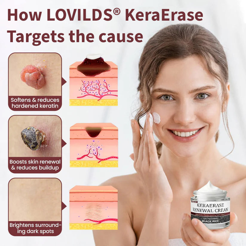 ✅Flash Sale - LOVILDS®KeraErase Dual-Action Renewal Cream
