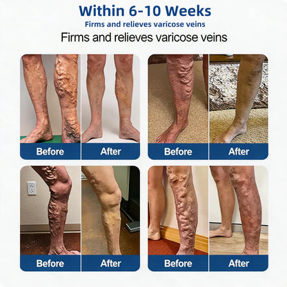🇺🇸👨‍⚕️✅TAILEDEN® 𝑽𝗲𝗶𝙣 𝘾𝐨𝐧𝘁𝗼𝙪𝙧 𝙈𝙞𝐜𝐫𝒐𝒏𝒆𝗲𝗱𝗹𝙚 𝙋𝙖𝐭𝐜𝒉 𝒘𝒊𝘁𝗵 𝗔𝙙𝙫𝙖𝙣𝙘𝐞𝐝 𝐃𝒊𝒐𝒔𝗺𝙞𝐧 & 𝑯𝒆𝘀𝗽𝗲𝙧𝙞𝙙𝙞𝐧 𝐃𝒆𝒍𝒊𝒗𝗲𝗿𝙮🌿𝟕-𝐃𝐚𝐲 𝐕𝐢𝐬𝐢𝐛𝐥𝐞 𝐑𝐞𝐬𝐮𝐥𝐭𝐬 𝐟𝐨𝐫 𝐕𝐚𝐫𝐢𝐜𝐨𝐬𝐞 𝐕𝐞𝐢𝐧𝐬