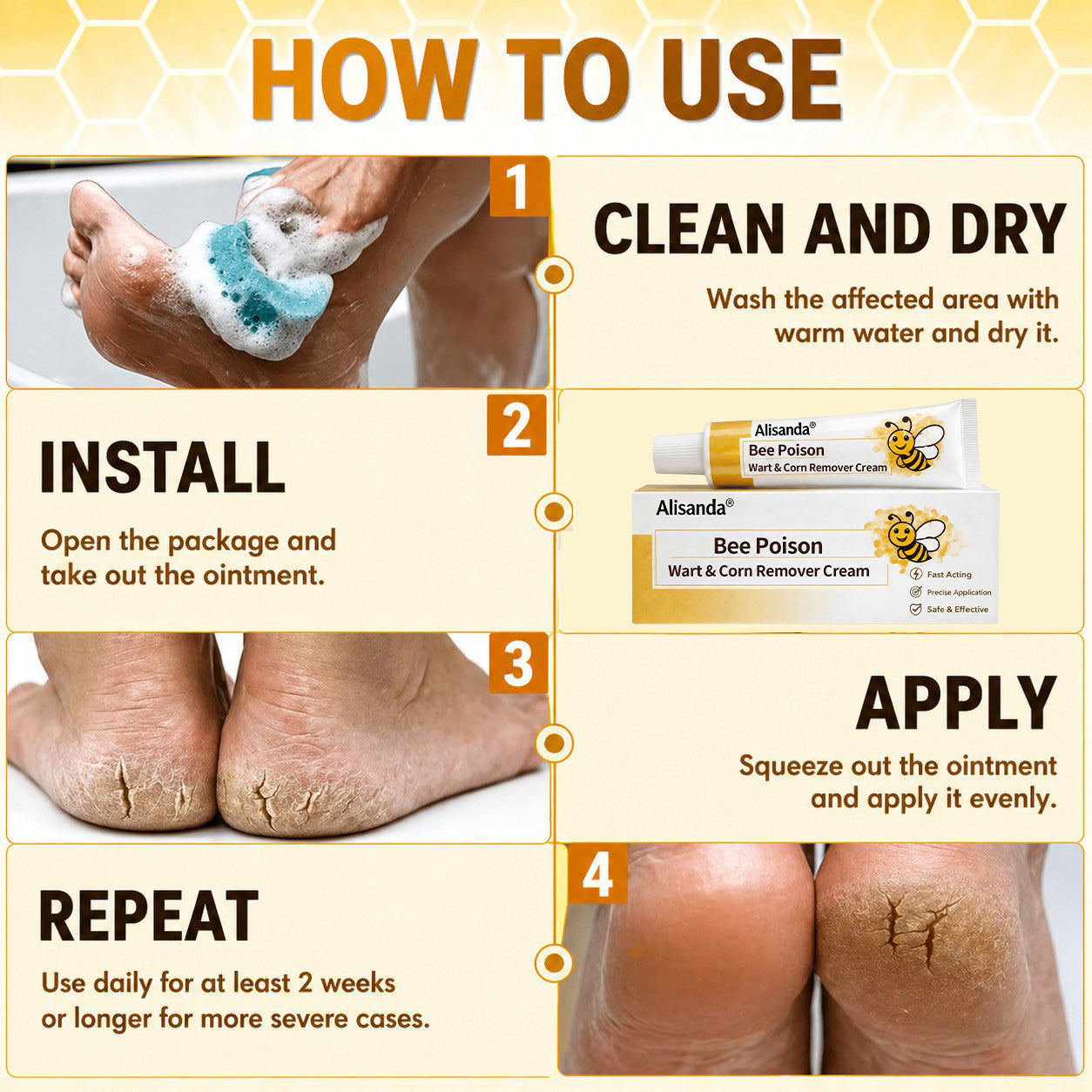 👨‍⚕️Alisanda®Bee Poison Wart & Corn Remover Cream⚡