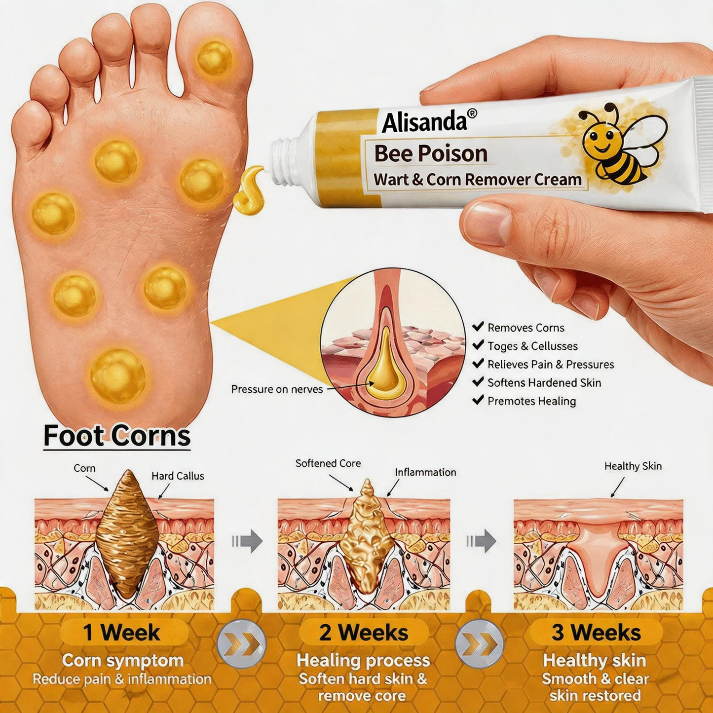 👨‍⚕️Alisanda®Bee Poison Wart & Corn Remover Cream⚡