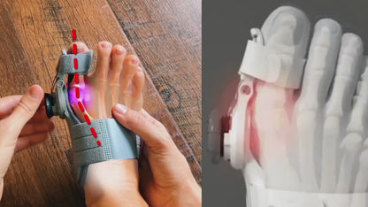 Alisanda® - Non-Surgical Relief for Bunion Pain